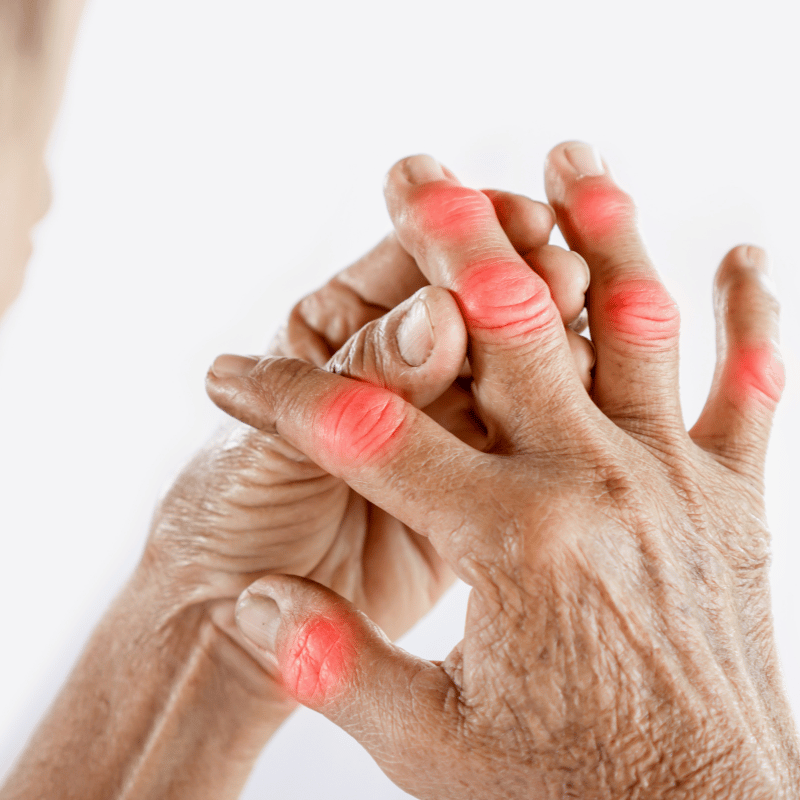 Gout Treatment